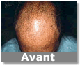 implant de cheveux
